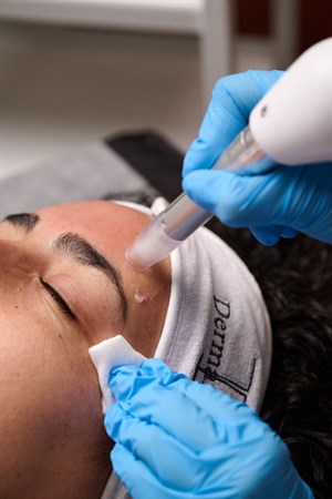 Microneedling
with
XCellaris PRO TWIST
Photo
